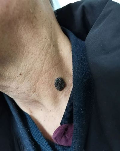 身上痣疤的八字